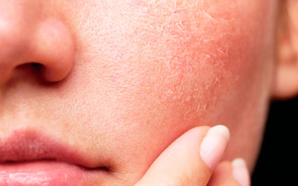 Las causas más comunes de la piel reseca y cómo tratarla.... 🧴 👩🏻 